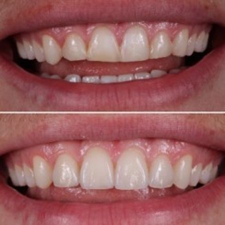 Veneers Vorher zu Nacher